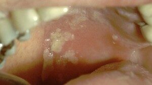 gerpeticheskij-stomatit-300x167-6998391